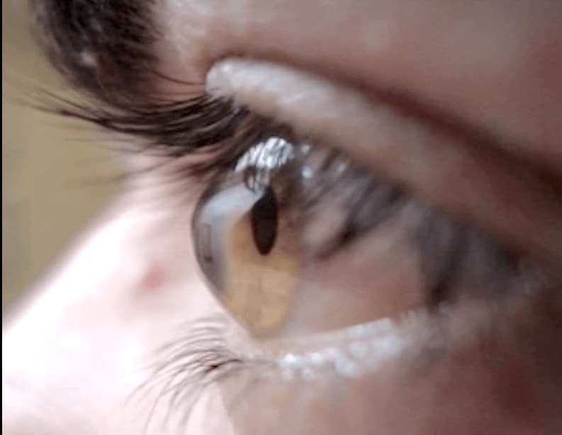 Procedura di trattamento laser per ridurre la pressione intraoculare nel glaucoma. Procedura di trattamento laser per ridurre la pressione intraoculare nel glaucoma.