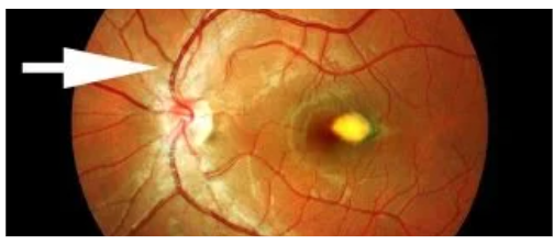 Procedura di trattamento laser per ridurre la pressione intraoculare nel glaucoma. Procedura di trattamento laser per ridurre la pressione intraoculare nel glaucoma.